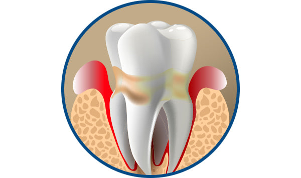 Improvement of periodontal disease